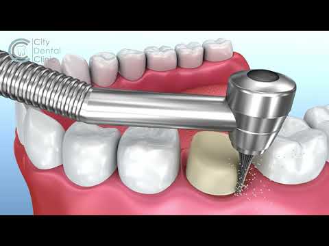 Zahnkrone Behandlungsablauf Animation