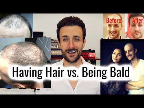 Having Hair vs. Being Bald - My Experience