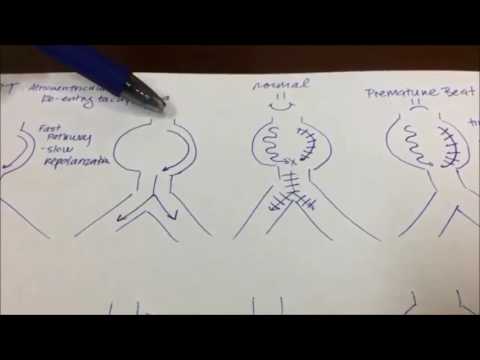 AVNRT AV Nodal Reentrant Tachycardia Interventional Cardiology Electrophysiology Cardiac Pacing