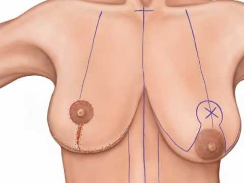 วิธีการเพิ่มเต้านมสาว 14 เวลาน้อยแรกเกิด suckles