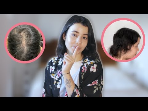 How to Survive Losing Your Hair (6 Tips for Dealing with Hair Loss) | My Hair Loss Journey