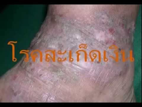 ร้องไห้กลากรักษาเยียวยาชาวบ้าน วิตามินกลาก
