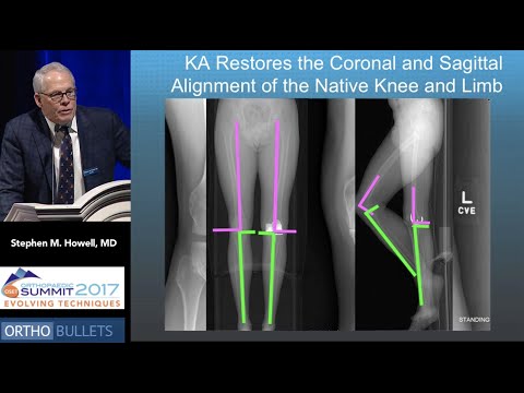 Pro: Kinematic Alignment Is All That Matters! - Stephen M. Howell, MD