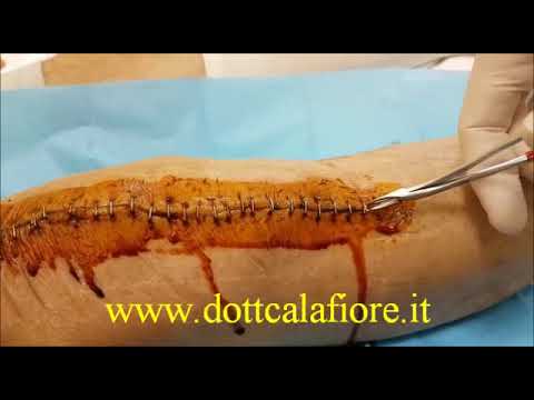 Se osteocondrosi progredisce Sublussazione dellarticolazione del gomito negli adulti