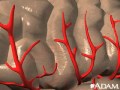 Stroke Secondary To Cardiogenic Embolism