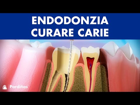 Endodonzia – Curare carie profonda ©