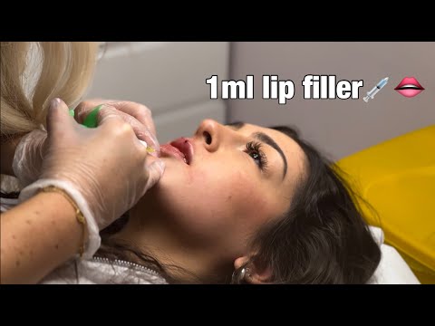 I got lip fillers for the first time!!!