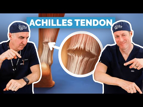 Achilles Tendon Rupture - Do You Need Surgery?
