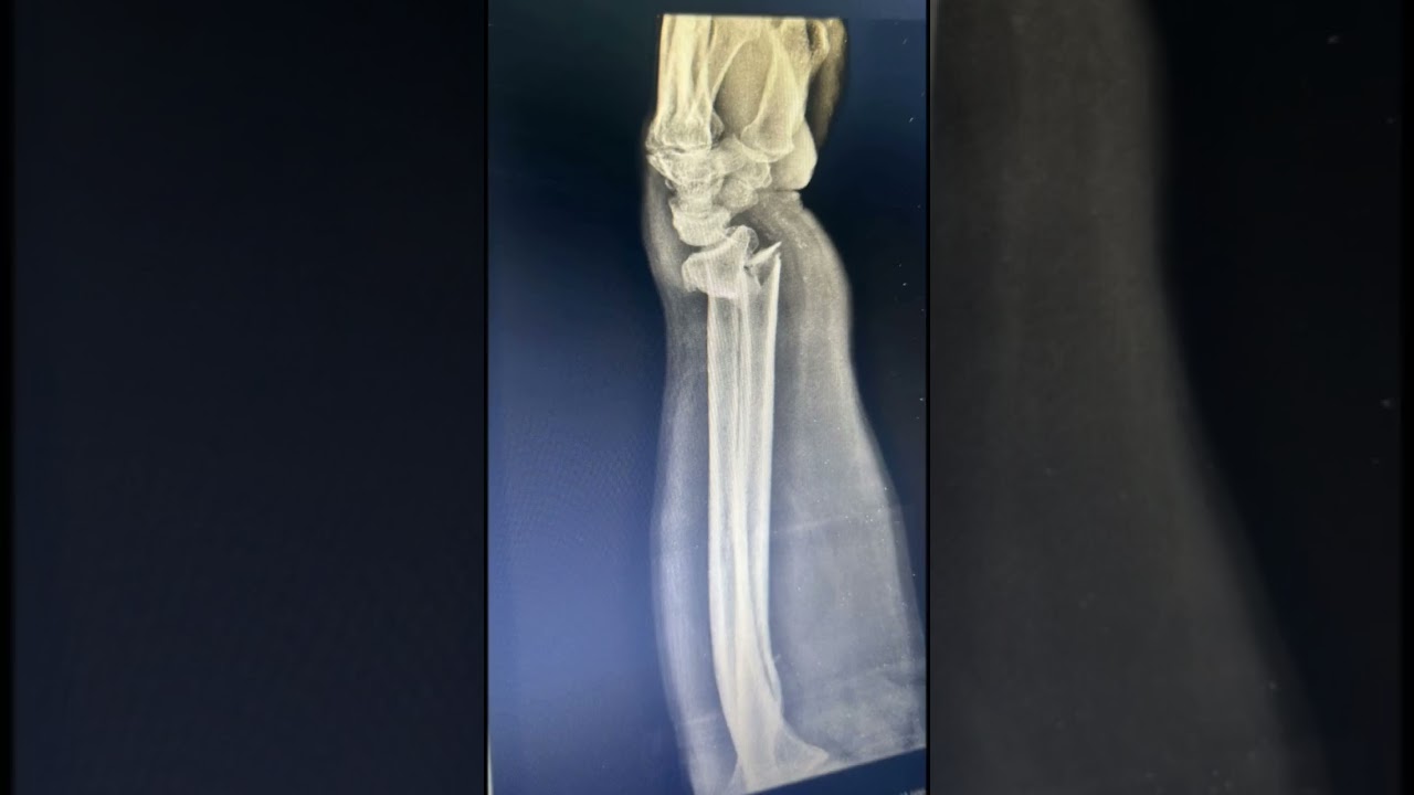 Distal Radius Fracture treated by ORIF