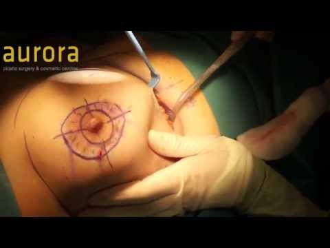 PIP Replacement and Areola Reduction - Aurora Clinics