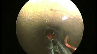 preview picture of video 'Cricopharyngoscopy - Chicken Bone'
