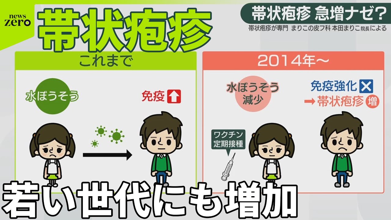 【帯状疱疹】強い痛みも…若い世代にも増加  日常生活で気をつけることは？