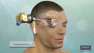Keyhole Surgery: Minimally Invasive Way for Brain Tumor Removal | SurgeryLog