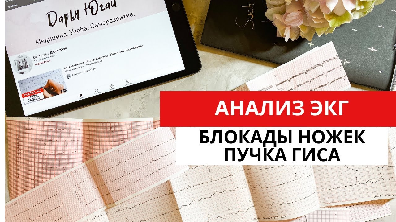Блокада правой и левой ножек пучка Гиса. ЭКГ диагностика. Двухпучковая, трехпучковая блокады.