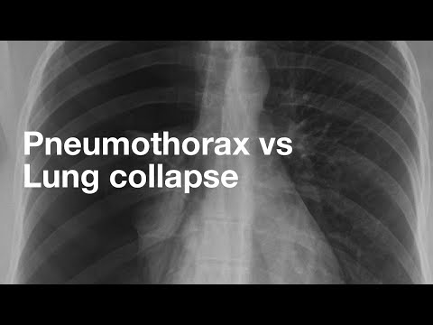 Pneumothorax vs. Lungenkollaps