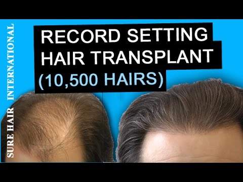 10,500 Hair Transplant in Toronto @ Sure Hair...