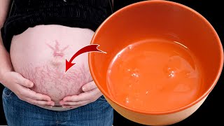 Stretch marks Immediately and Permanently Removed | Home Remedy for Stretch Marks