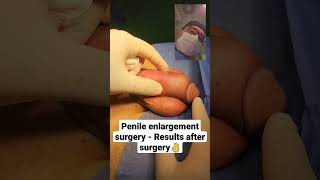 Download lagu Penile Enlargement Surgery - Results after surgery - Op. Dr. Araz Bayramov - penilenlargement.com mp3 Download lagu Penile Enlargement Surgery - Results after surgery - Op. Dr. Araz Bayramov - penilenlargement.com mp3