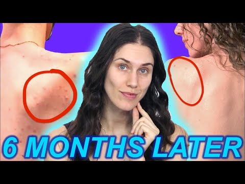 How I FINALLY Got my Body Acne to Behave...