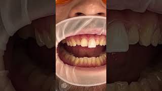 Veneers Process