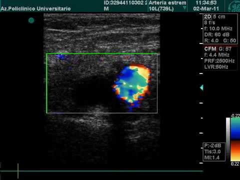 Common Femoral Vein Thrombosis And Superficial Femoral Artery Occlusion In Doppler Exam