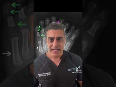 Polydactyly Explained