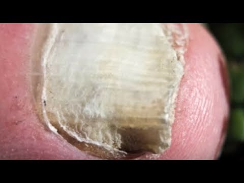 Gribok die Füsse ohne Tabletten zu heilen Was wenn bei der Schwangeren gribok auf dem Nagel zu machen