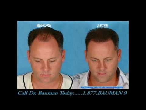 AMAZING Before and After Hair Transplant Transformations