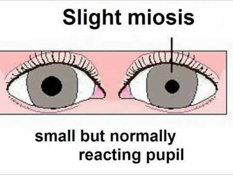 comment guerir ptosis