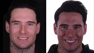 Ian Elkins Smile Makeover Testimonial by New York Cosmetic Dentist Dr. Alex