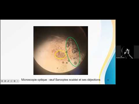 Prise en charge de la gale