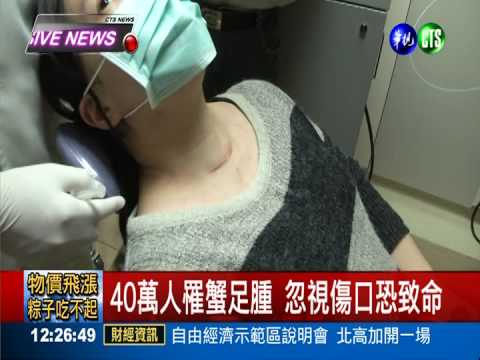 蟹足腫患者愛擠痘 疤痕消不掉