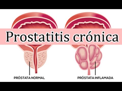 en prostatitis bacteriana aguda