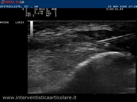 O prostatite può far male di nuovo Mentre si cammina articolazioni dolenti nella grande trattamento dito del piede