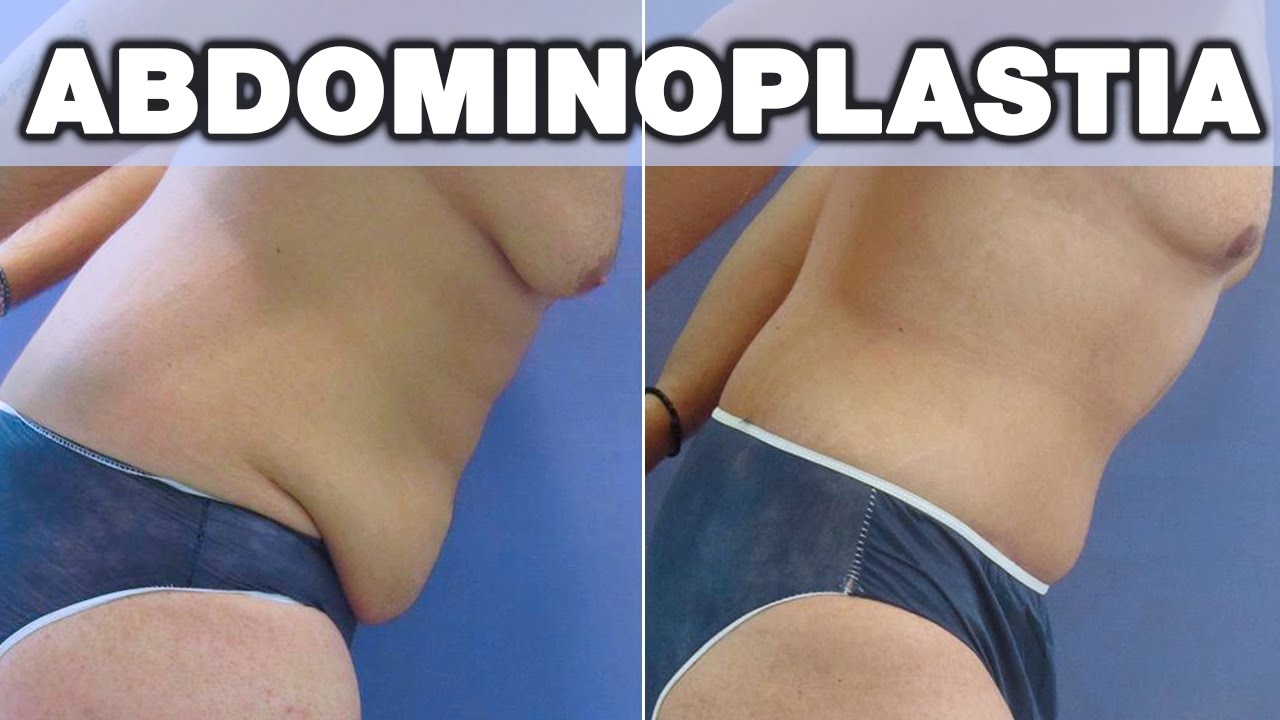 Abdominoplastia en Hombres | Testimonio de José Manuel