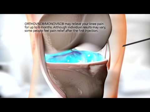 Modi Mundi Pharma Pvt Ltd Monovisc 2.5 4 Ml Injection, Packaging: 4Ml Pfs