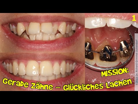 2 Wochen "leiden" - ein Leben lang STRAHLEN ! Sympathie und Charisma gewinnen mit schönen Zähnen