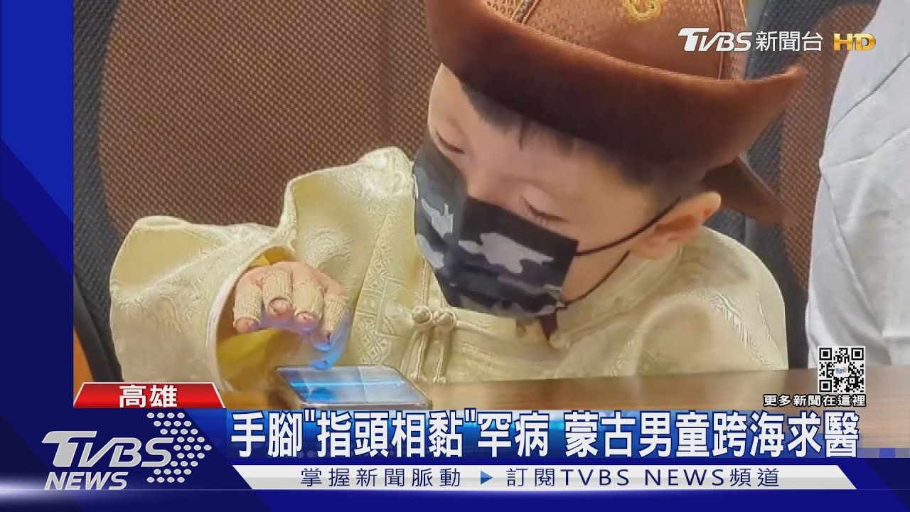 手腳「指頭相黏」 蒙古5歲男童患罕病!跨海來台求醫