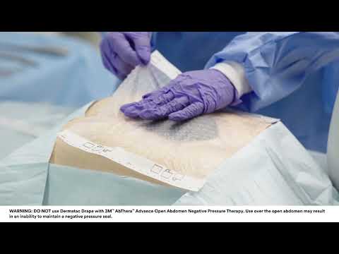 3M™ V.A.C.® Dressing Basic Application using 3M™ Dermatac™ Drape