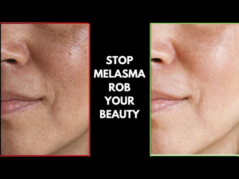 ✨10 Days Melasma Challenge: A magical remedy for Melasma and Hyper-pigmentation