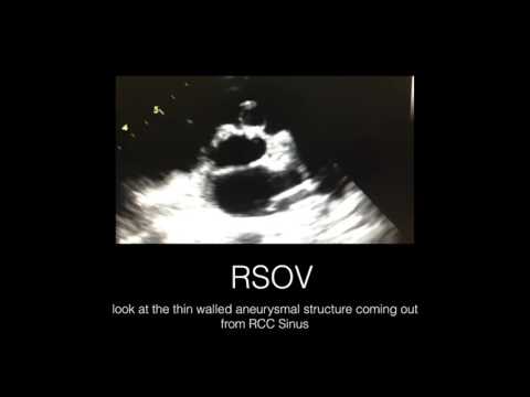 Ruptured Sinus of Valsalva, A Rare Clinical Entity