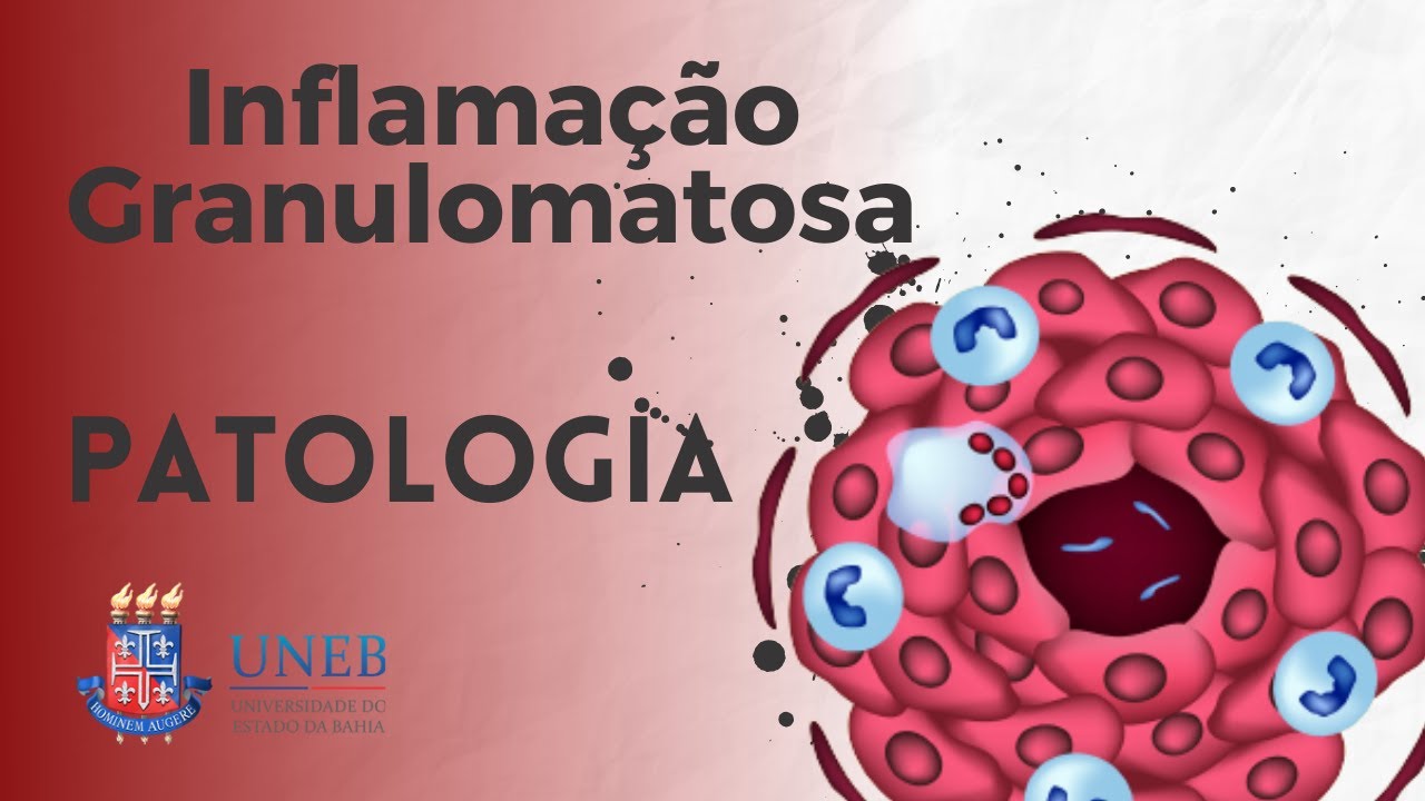 Inflamação Granulomatosa