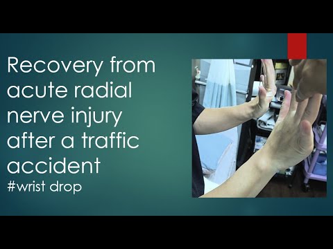 #12 Recovery from acute radial nerve injury after a traffic accident