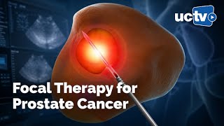 Focal Therapy for Prostate Cancer: Why, Who, and How?