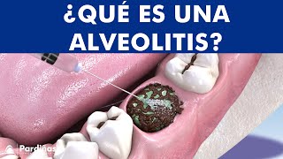 ALVEOLITIS DENTAL - Infección tras extracción de muela: causas y tratamiento © - Clínica Dental Pardiñas