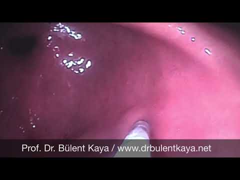 Prof. Dr. Bülent Kaya - Mide su Uygulaması