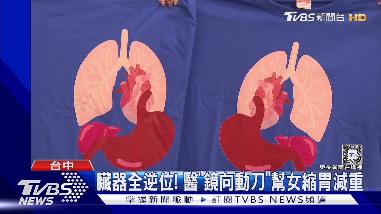 臟器全逆位!醫「鏡向動刀」 幫女縮胃減重