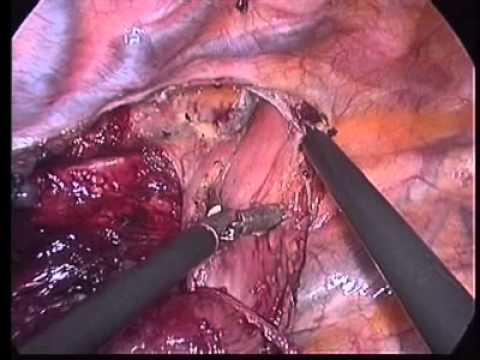 Torakolaparoskopowa ezofagektomia w pozycji Prona z powodu nowotworu przełyku