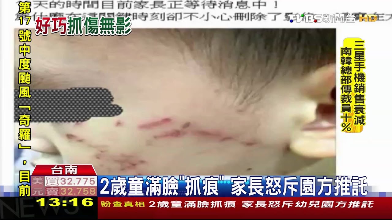 2歲童滿臉「抓痕」 家長怒斥園方推託
