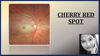 Cherry Red Spot & its Causes | Retina | Ophthalmology